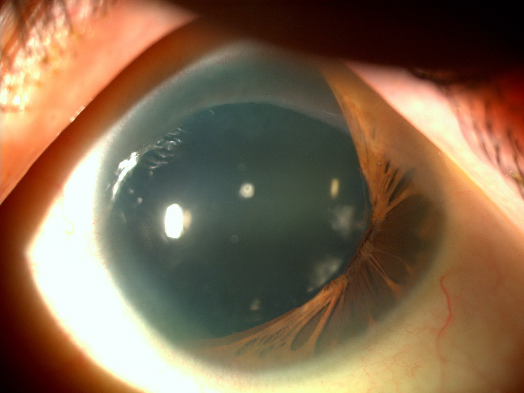 Aniridia 1 Hereditary Ocular Diseases 9037